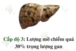 Gan nhiễm mỡ độ 3 – Điều trị sớm kẻo bệnh biến chứng