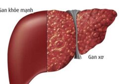 Tất tần tật thông tin cần biết về bệnh xơ gan