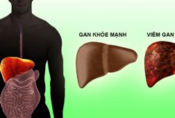 Coi chừng trước những triệu chứng của bệnh viêm gan  
