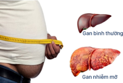Nhận biệt và điều trị gan nhiễm mỡ độ 2