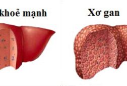 Bệnh xơ gan có lây không?Câu trả lời xác đáng từ chuyên gia