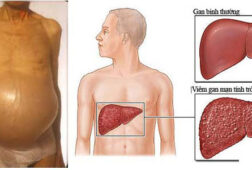 Giải đáp: Bệnh xơ gan cổ trướng có chữa được không?